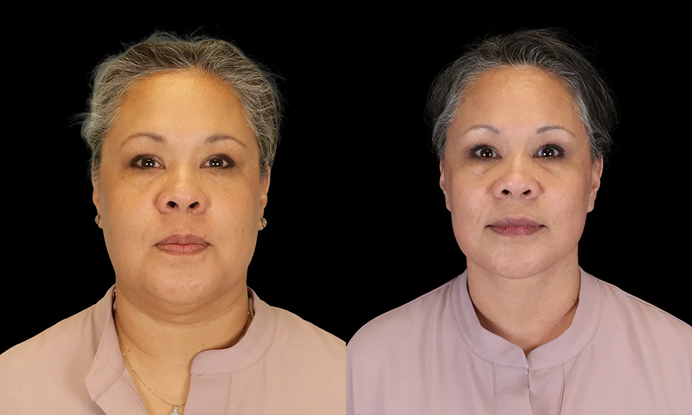Real patient results in New York, NY Performed by Sameer Halani, MD