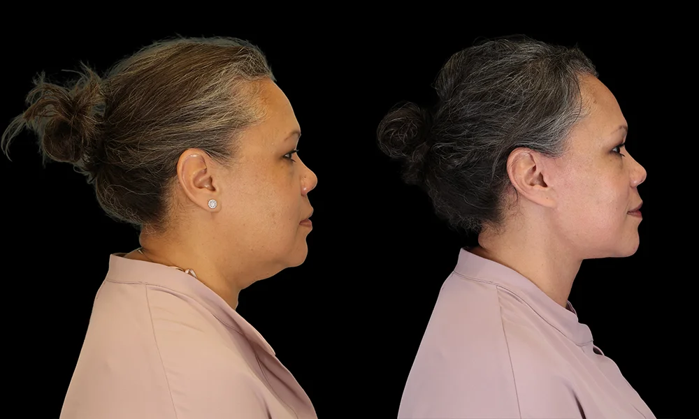 Real patient results in New York, NY Performed by Sameer Halani, MD