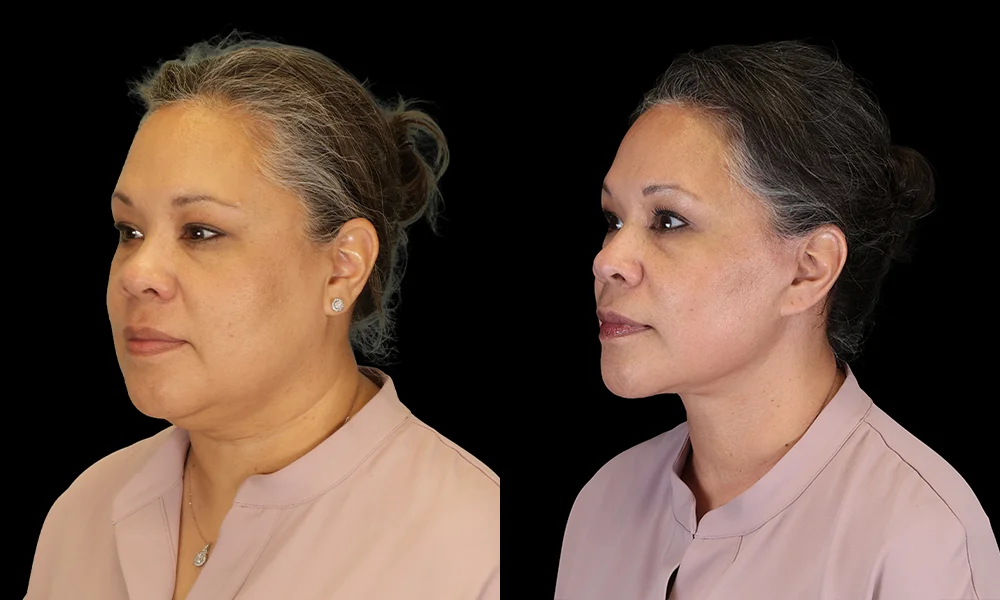 Real patient results in New York, NY Performed by Sameer Halani, MD