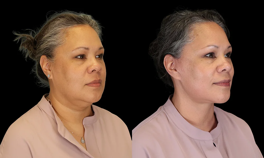 Real patient results in New York, NY Performed by Sameer Halani, MD