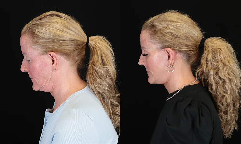 Real patient results in New York, NY Performed by Sameer Halani, MD