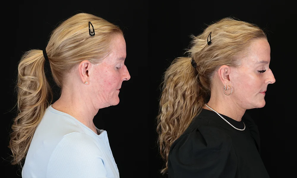 Real patient results in New York, NY Performed by Sameer Halani, MD