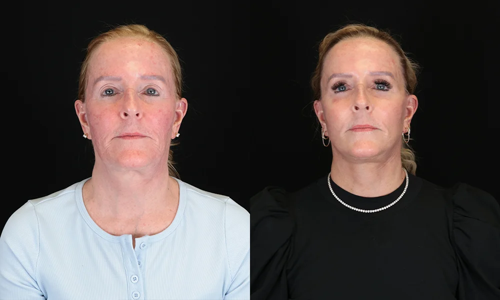 Real patient results in New York, NY Performed by Sameer Halani, MD