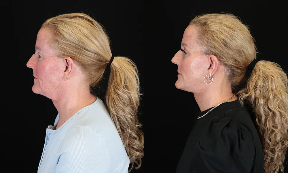 Real patient results in New York, NY Performed by Sameer Halani, MD