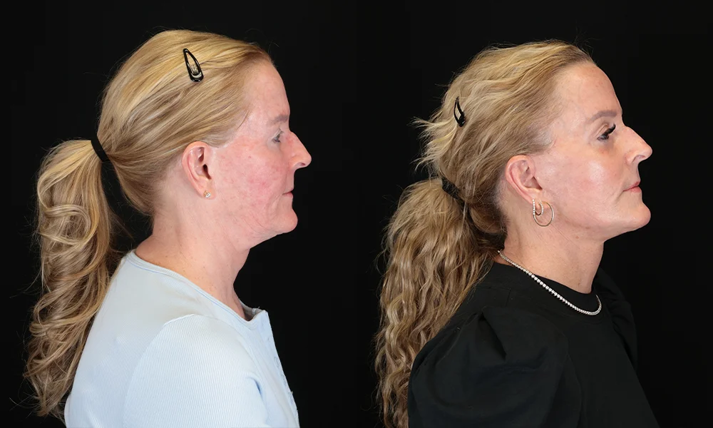 Real patient results in New York, NY Performed by Sameer Halani, MD
