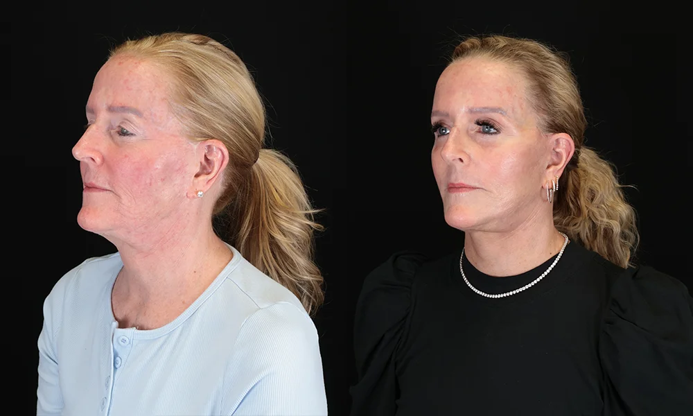 Real patient results in New York, NY Performed by Sameer Halani, MD