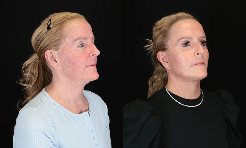 Real patient results in New York, NY Performed by Sameer Halani, MD