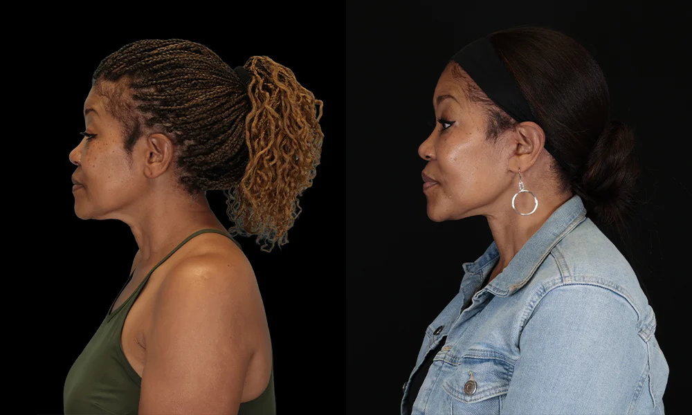 Real patient results in New York, NY Performed by Sameer Halani, MD