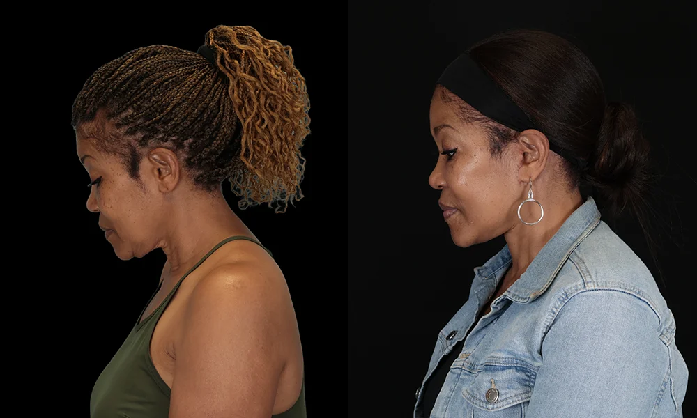 Real patient results in New York, NY Performed by Sameer Halani, MD