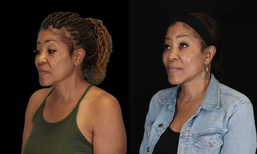 Real patient results in New York, NY Performed by Sameer Halani, MD