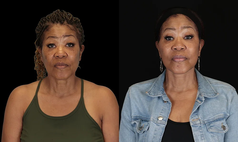 Real patient results in New York, NY Performed by Sameer Halani, MD