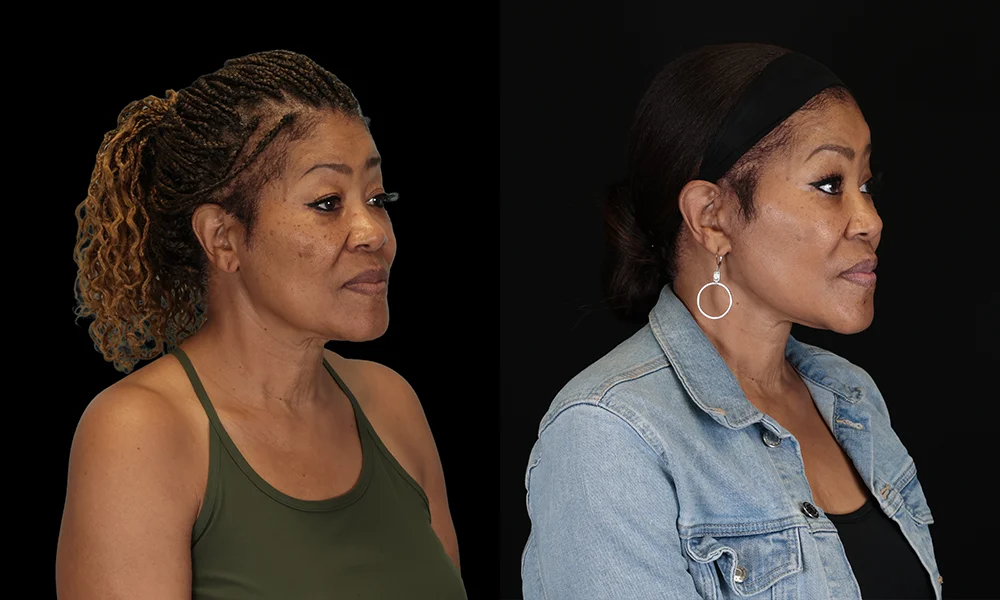 Real patient results in New York, NY Performed by Sameer Halani, MD