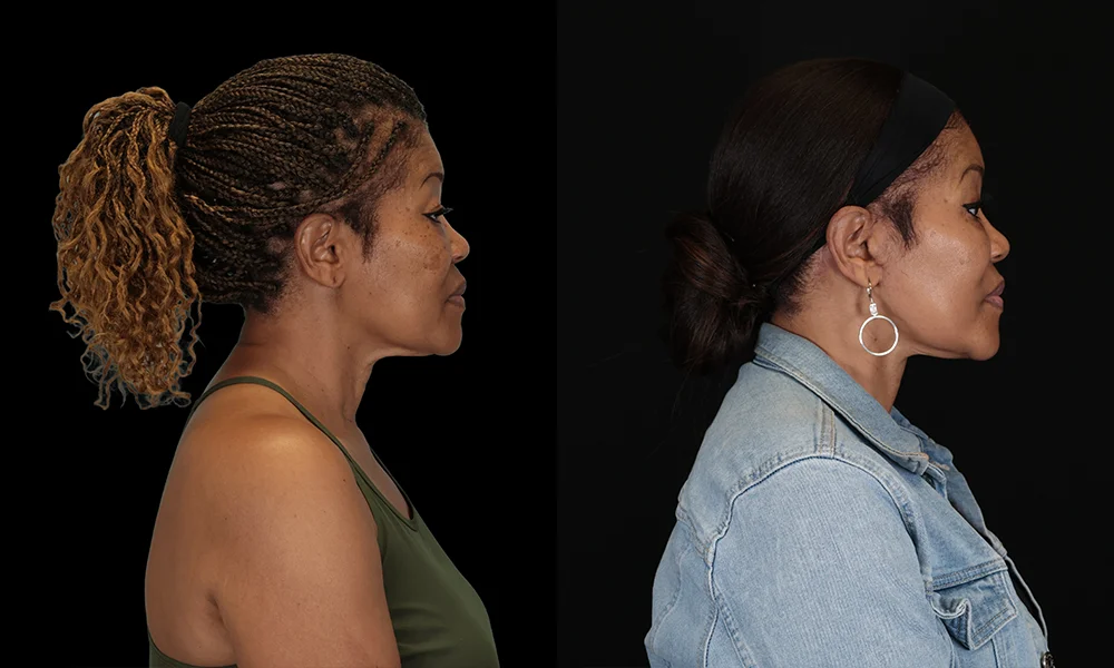 Real patient results in New York, NY Performed by Sameer Halani, MD