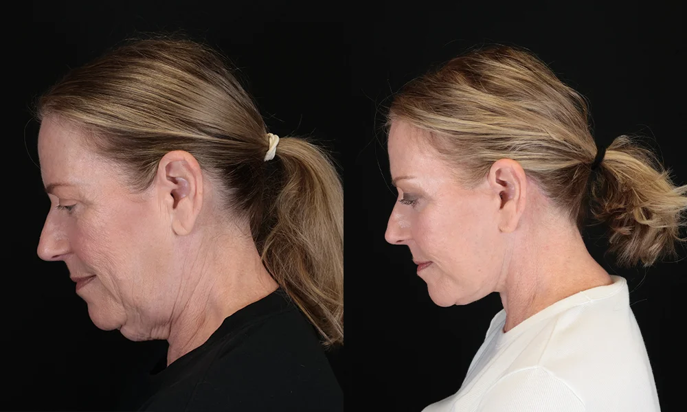 Real patient results in New York, NY Performed by Sameer Halani, MD
