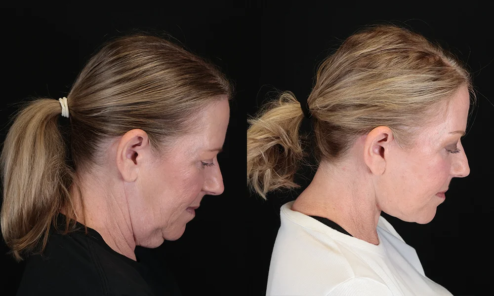 Real patient results in New York, NY Performed by Sameer Halani, MD