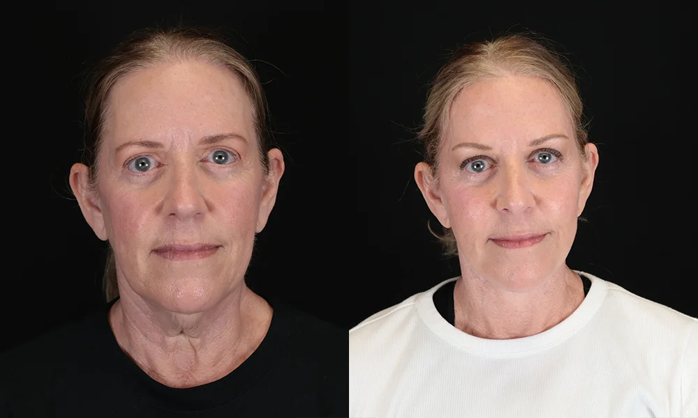 Real patient results in New York, NY Performed by Sameer Halani, MD