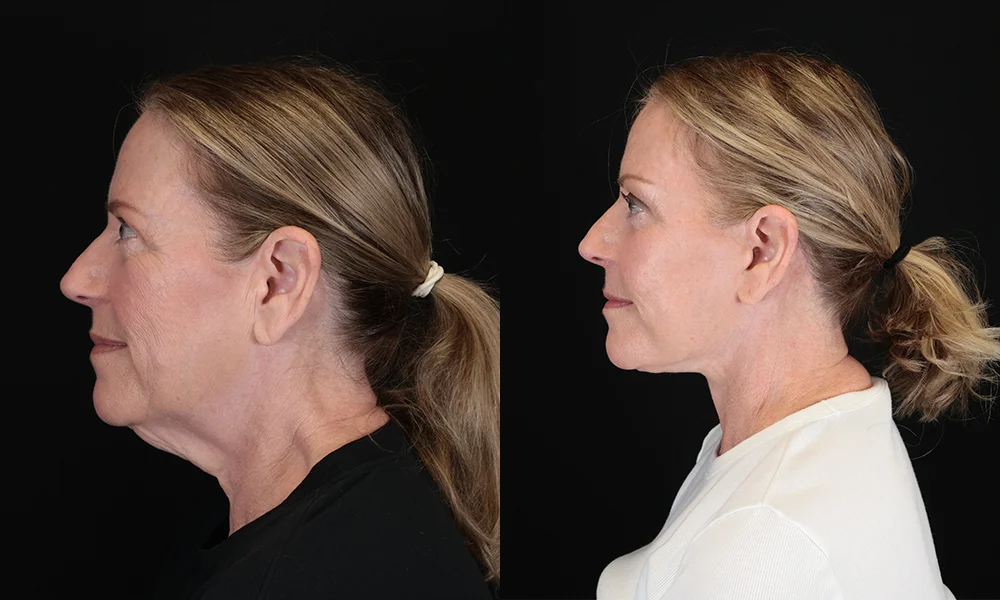 Real patient results in New York, NY Performed by Sameer Halani, MD