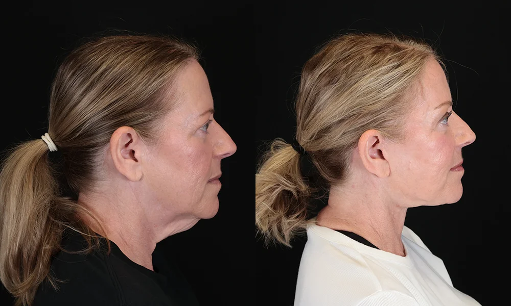 Real patient results in New York, NY Performed by Sameer Halani, MD