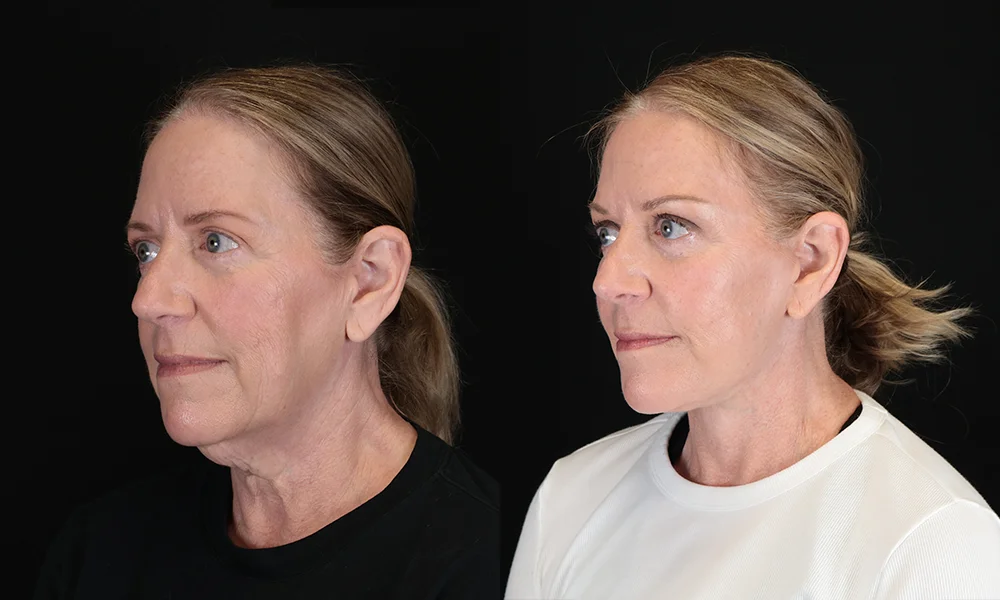 Real patient results in New York, NY Performed by Sameer Halani, MD
