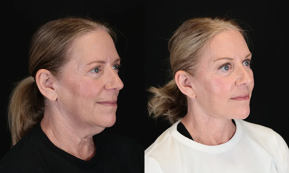 Real patient results in New York, NY Performed by Sameer Halani, MD