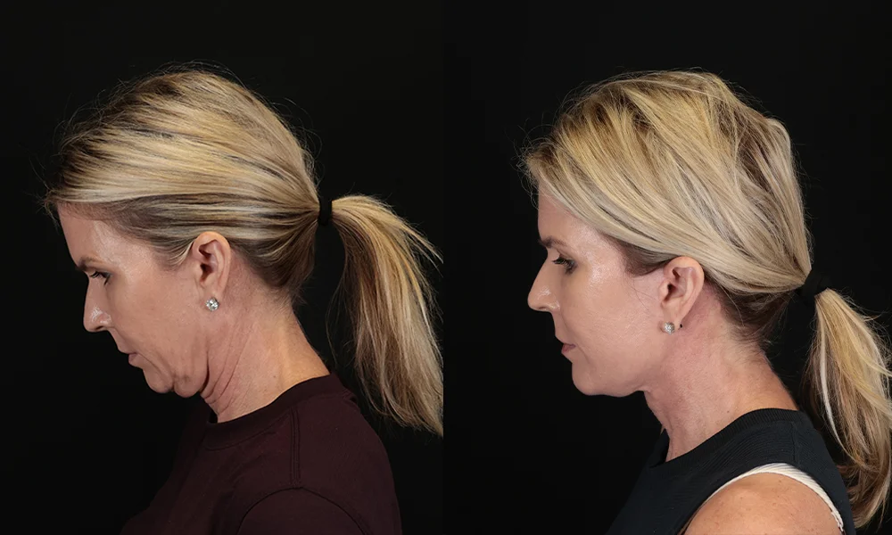 Real patient results in New York, NY Performed by Sameer Halani, MD