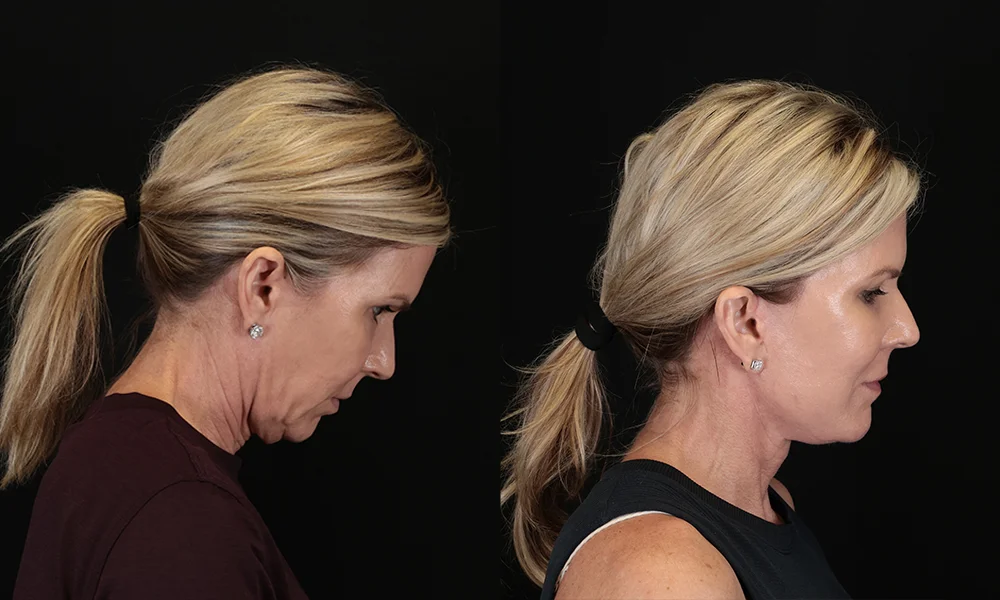 Real patient results in New York, NY Performed by Sameer Halani, MD
