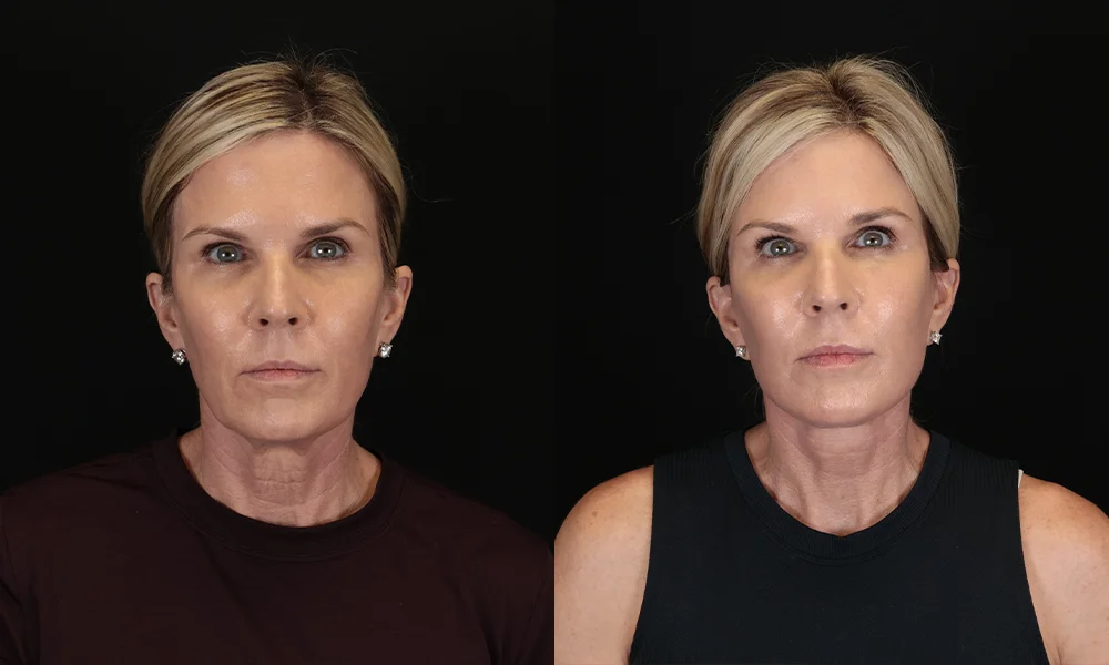Real patient results in New York, NY Performed by Sameer Halani, MD