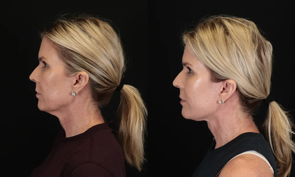 Real patient results in New York, NY Performed by Sameer Halani, MD