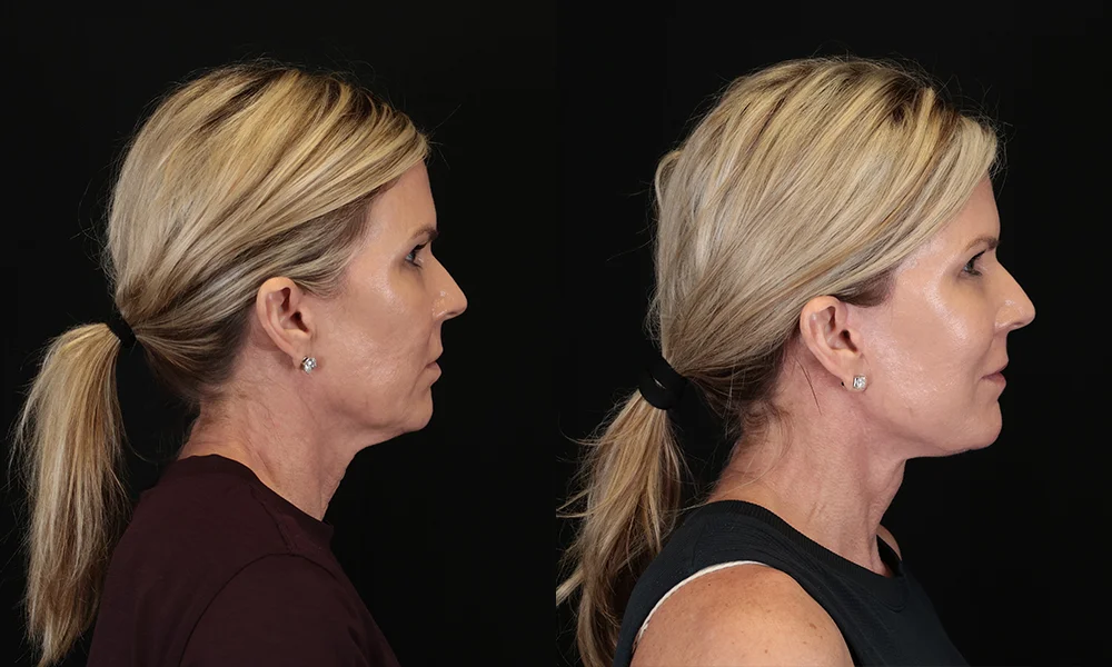 Real patient results in New York, NY Performed by Sameer Halani, MD