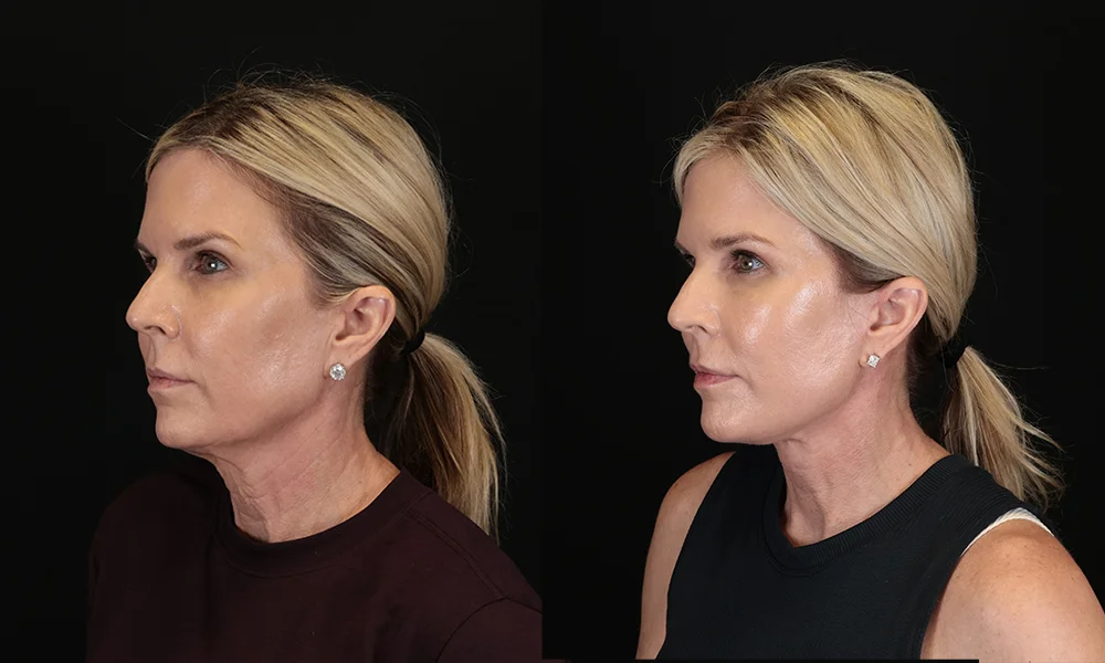 Real patient results in New York, NY Performed by Sameer Halani, MD