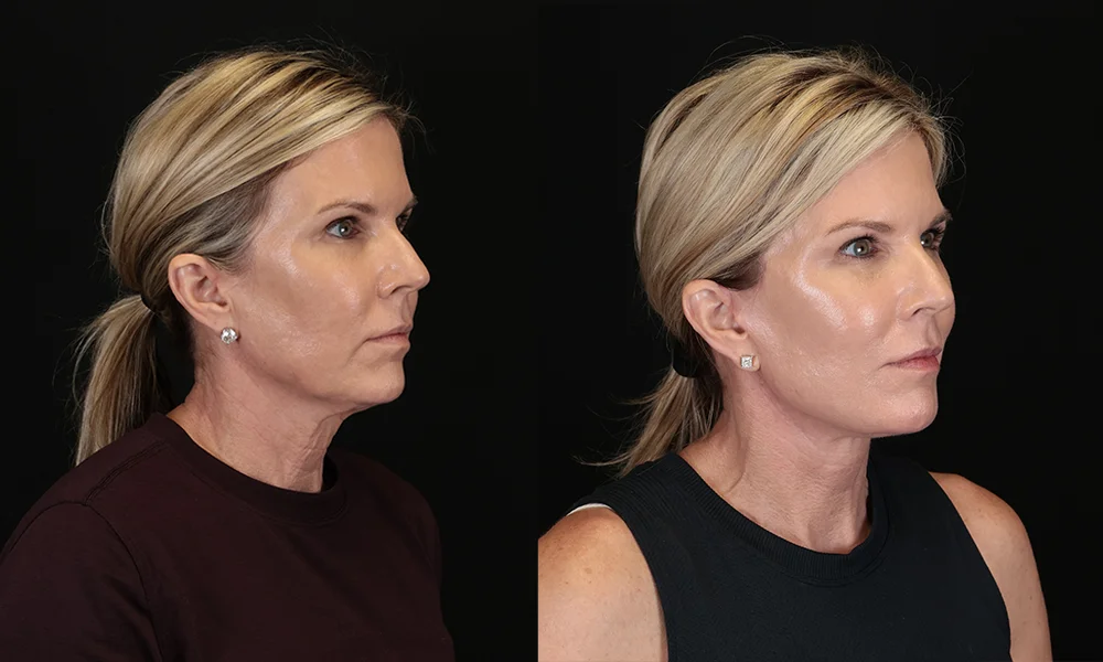 Real patient results in New York, NY Performed by Sameer Halani, MD