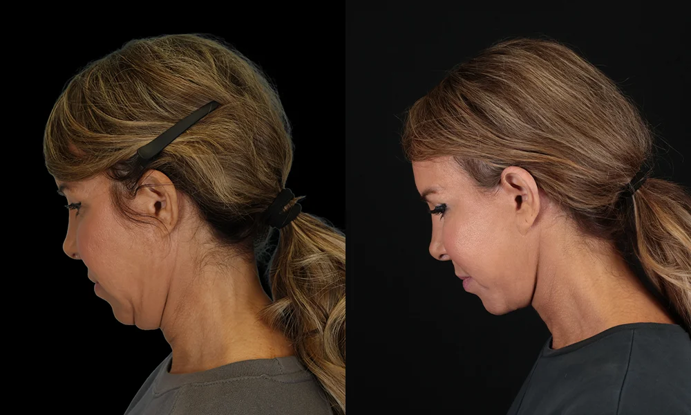 Real patient results in New York, NY Performed by Sameer Halani, MD