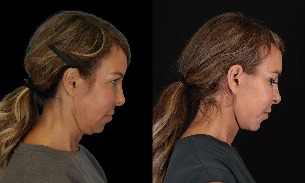 Real patient results in New York, NY Performed by Sameer Halani, MD