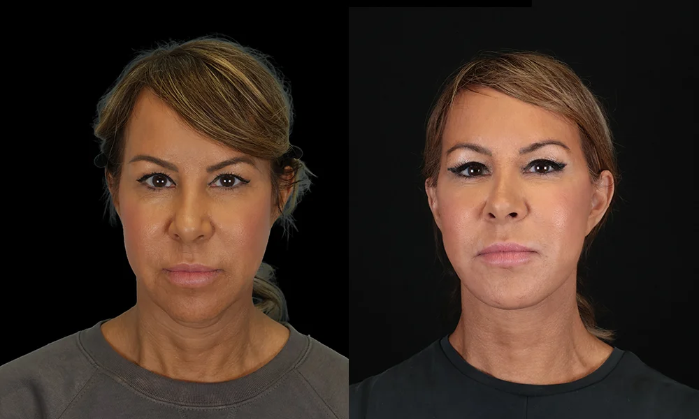 Real patient results in New York, NY Performed by Sameer Halani, MD