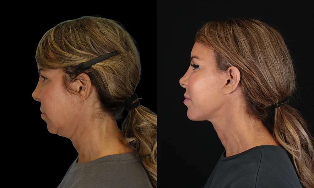 Real patient results in New York, NY Performed by Sameer Halani, MD
