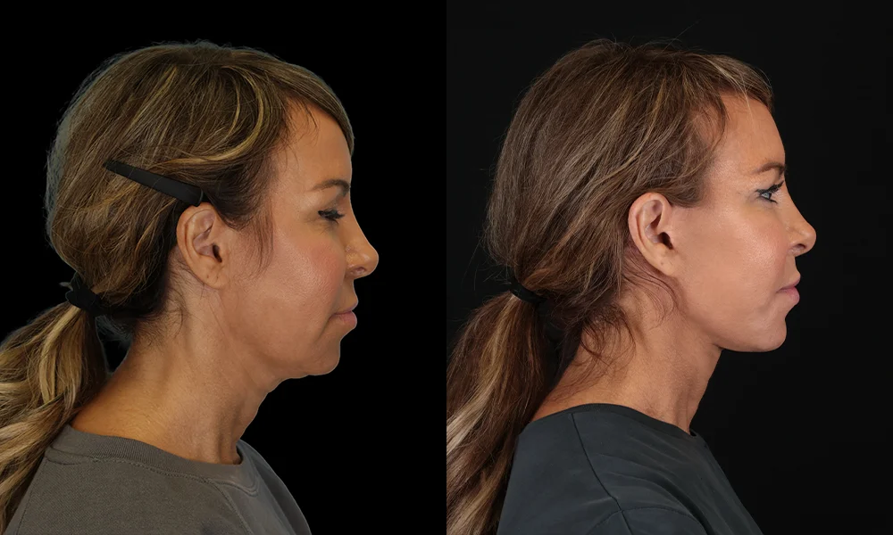 Real patient results in New York, NY Performed by Sameer Halani, MD