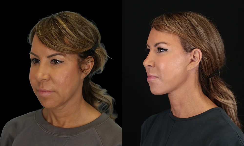 Real patient results in New York, NY Performed by Sameer Halani, MD