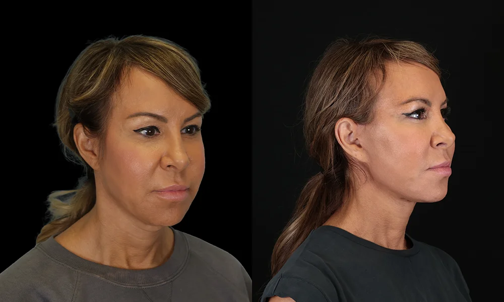Real patient results in New York, NY Performed by Sameer Halani, MD