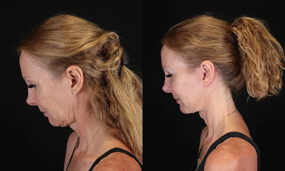 Real patient results in New York, NY Performed by Sameer Halani, MD