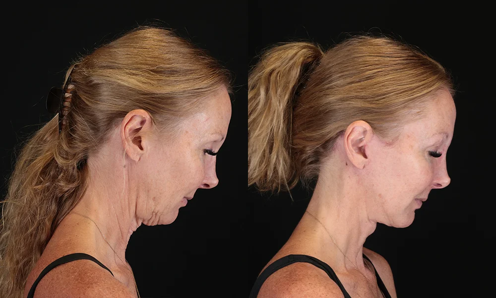 Real patient results in New York, NY Performed by Sameer Halani, MD