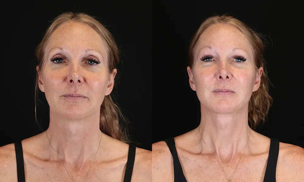 Real patient results in New York, NY Performed by Sameer Halani, MD