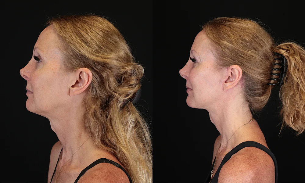Real patient results in New York, NY Performed by Sameer Halani, MD