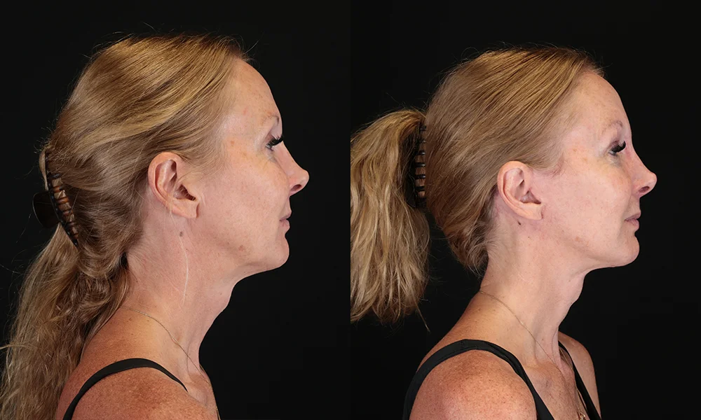 Real patient results in New York, NY Performed by Sameer Halani, MD