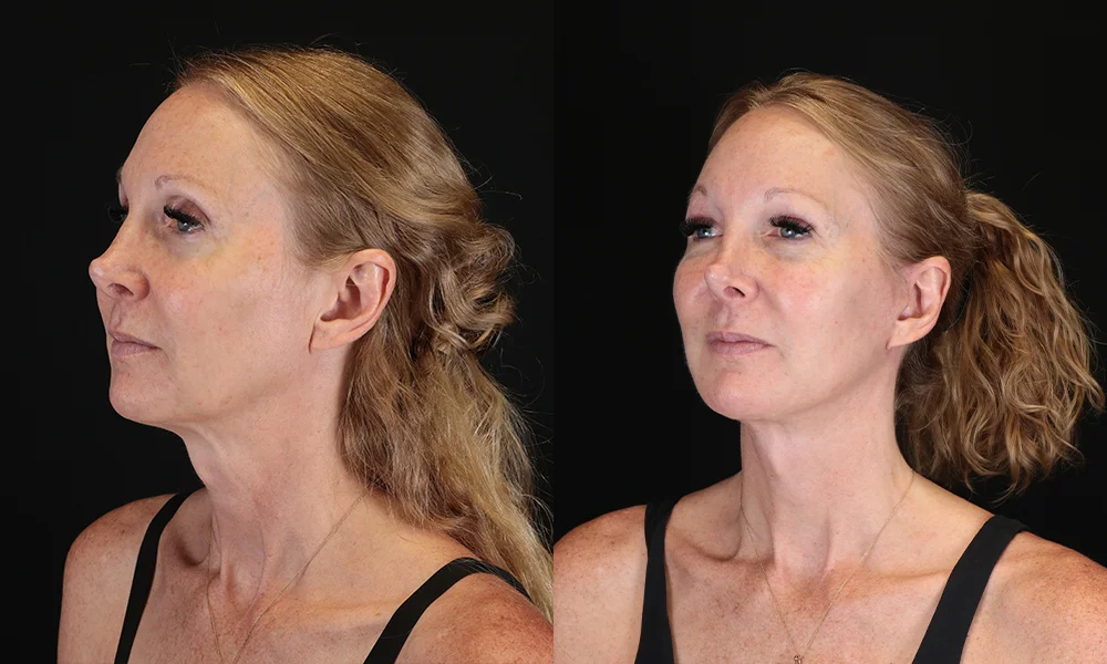 Real patient results in New York, NY Performed by Sameer Halani, MD