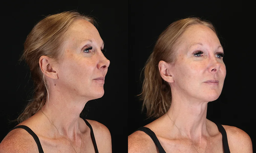 Real patient results in New York, NY Performed by Sameer Halani, MD