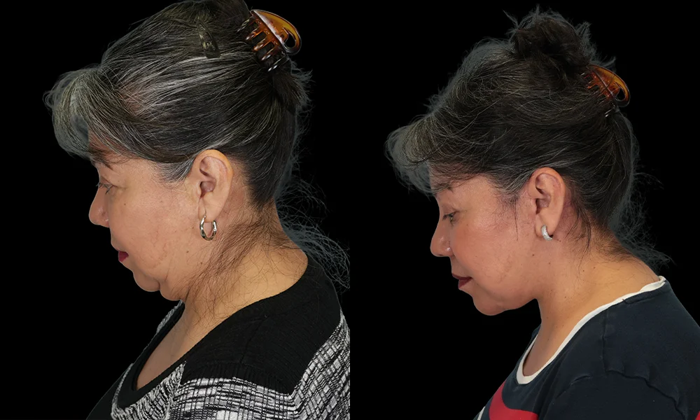 Real patient results in New York, NY Performed by Sameer Halani, MD