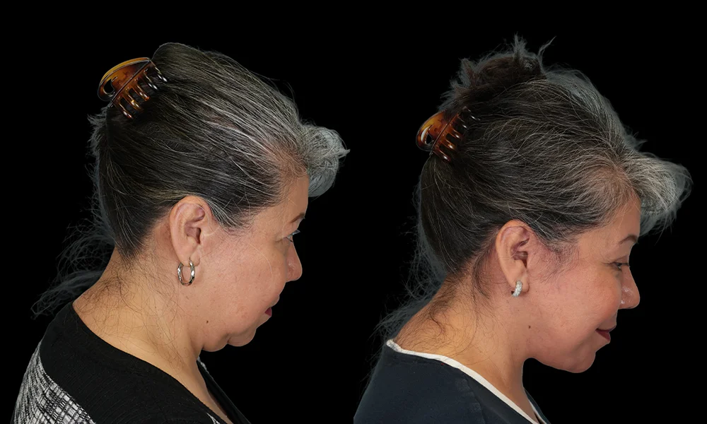 Real patient results in New York, NY Performed by Sameer Halani, MD