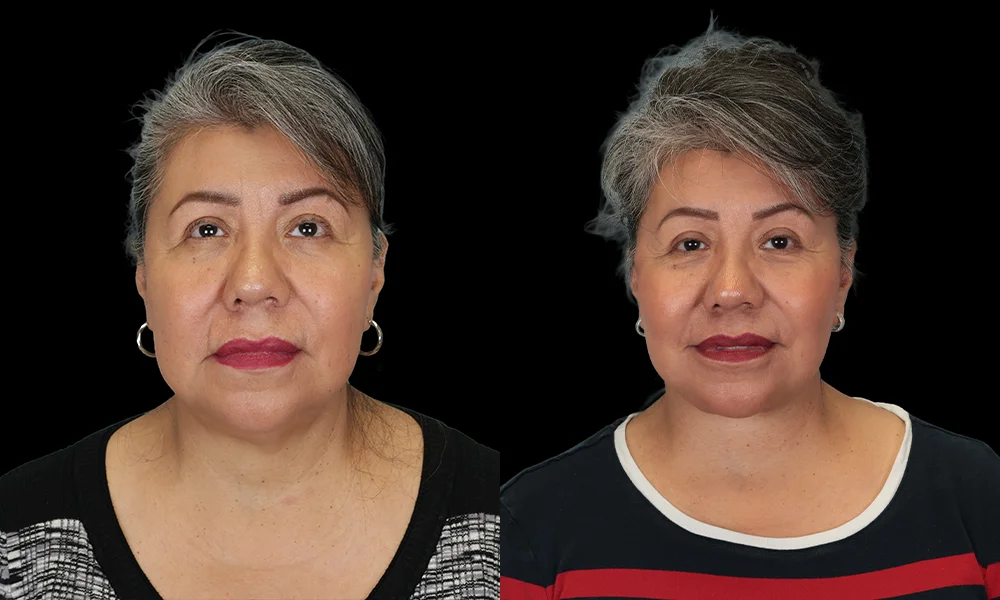 Real patient results in New York, NY Performed by Sameer Halani, MD