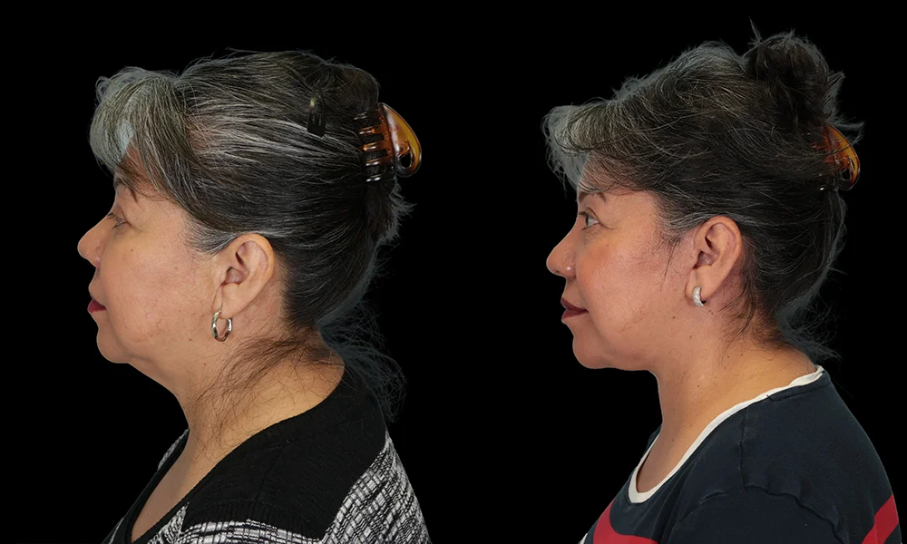 Real patient results in New York, NY Performed by Sameer Halani, MD