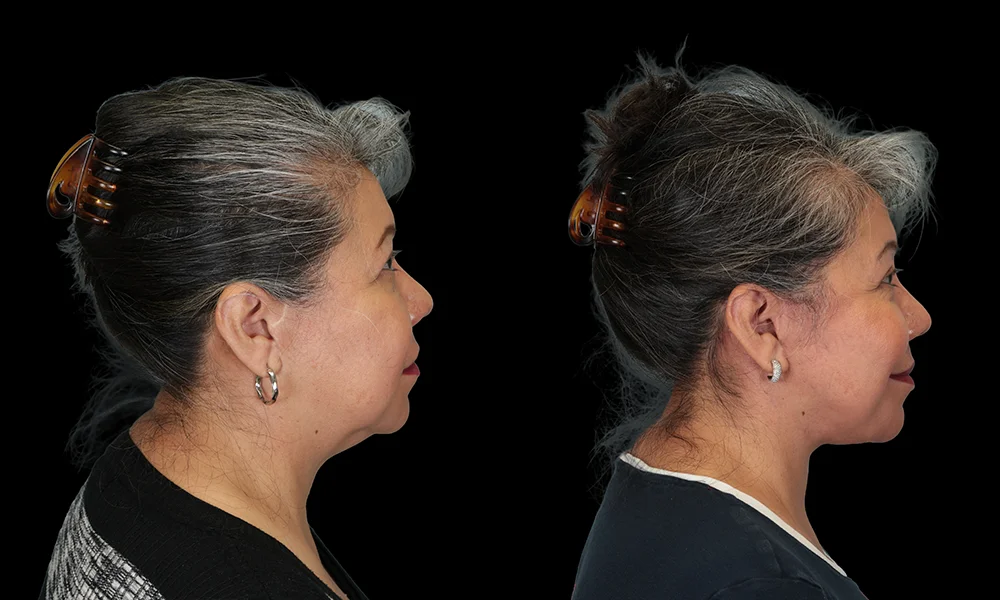 Real patient results in New York, NY Performed by Sameer Halani, MD